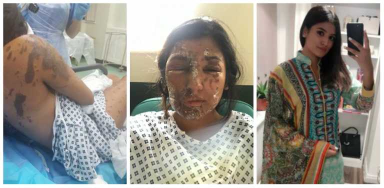 “I REFUSE TO DWELL” SAYS THE 21-YEAR-OLD ACID ATTACK SURVIVOR AS SHE POSTS HER INSPIRING POST-RECOVERY PICTURES
